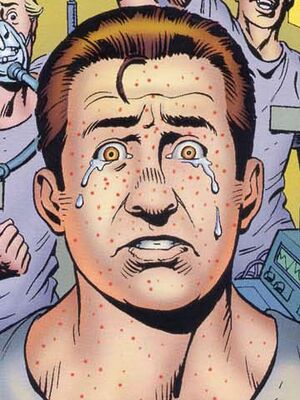 Measles.jpg